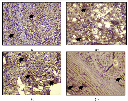 Histological and Immunohistochemical Analysis of Peri-Implant Soft and Hard Tissues in Patients with Peri-Implantitis