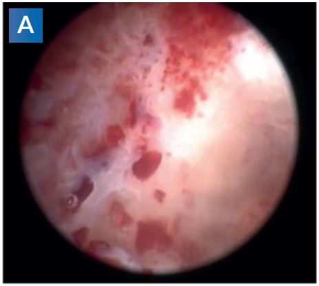 In situ endoscopic analysis of bone microstructure and vascularization in the post-explantation cavities from patients diagnosed with advanced peri-implantitis lesions: A preliminary report.