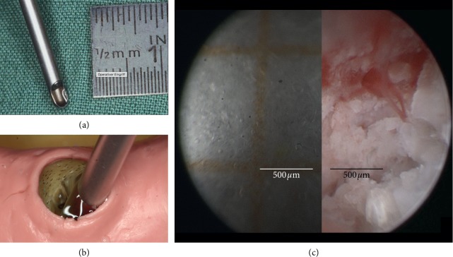 In Situ Endoscopic Analysis of Vascular Supply and Regenerated Alveolar Bone in <i>β</i>-TCP Grafted and Ungrafted Postextraction Sites before Implant Placement: A Prospective Case Control Study